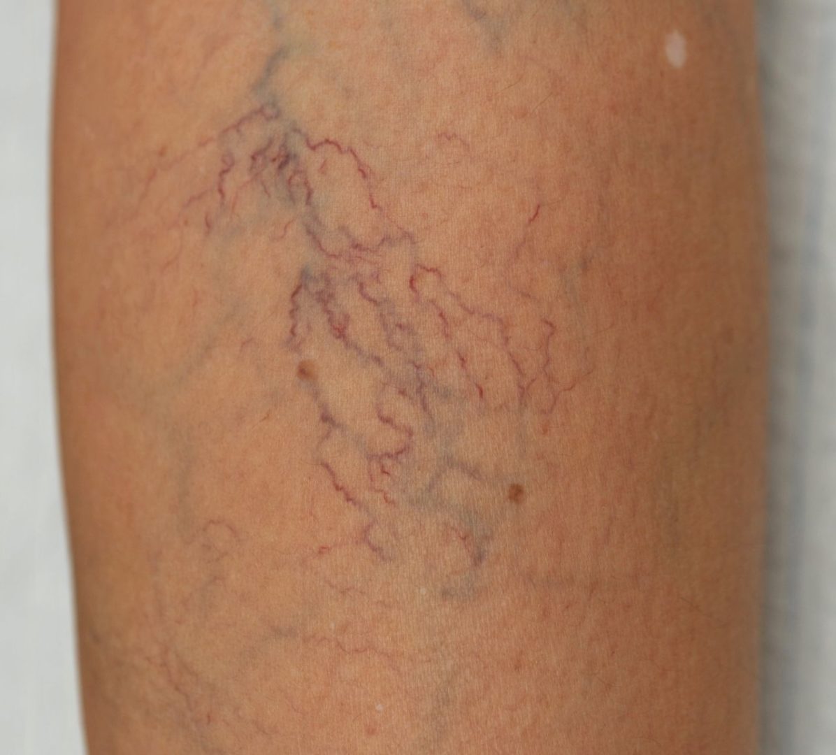 List 90+ Images spider veins on legs pictures Updated