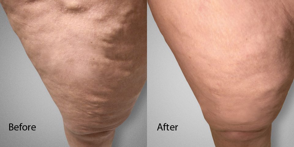 Spider vein removal deals nyc