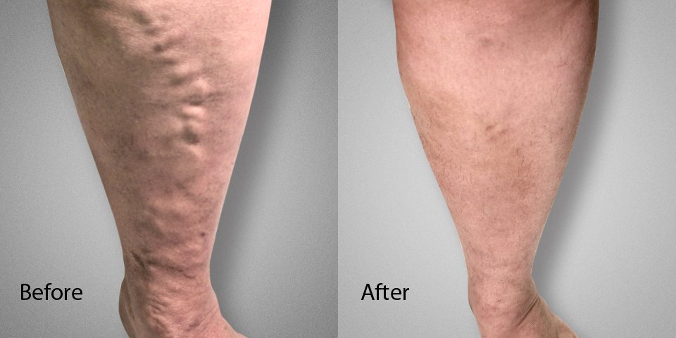 Spider vein removal deals nyc