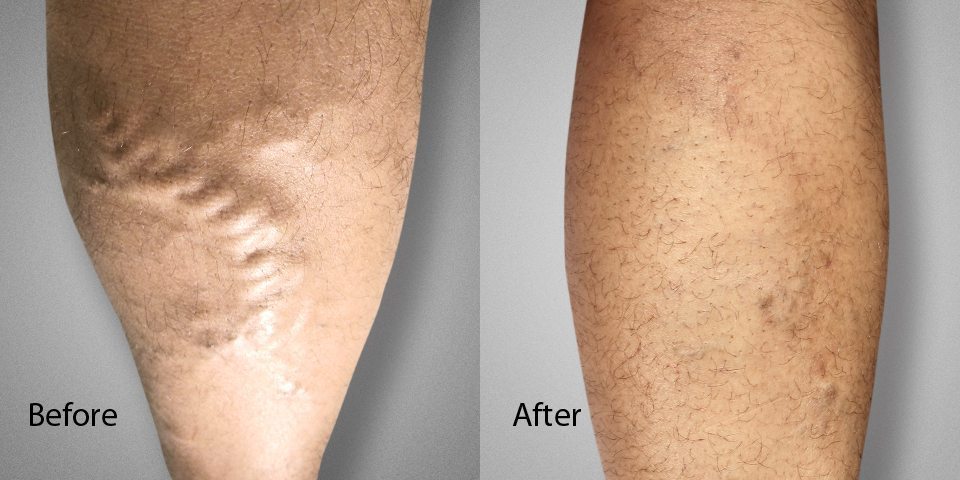 Spider vein removal deals nyc