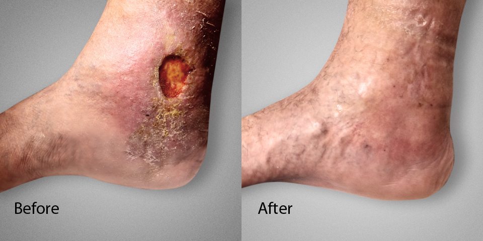 Spider vein removal deals nyc