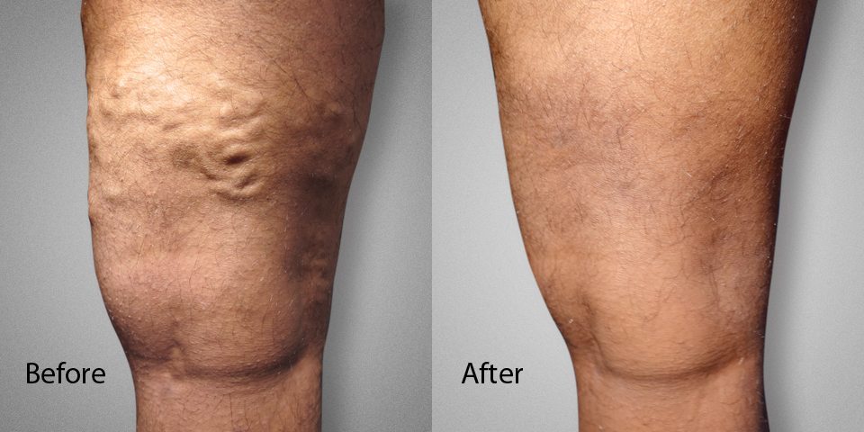 Spider vein removal deals nyc