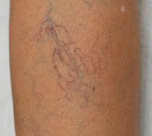Types of Spider Veins and Formations