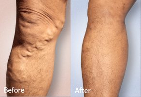 before and after photo of varicose vein treatment on the leg of a patient using ClariVein
