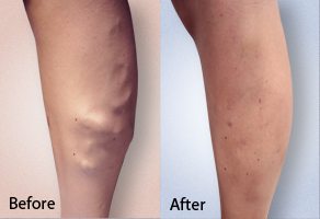 before and after photo of varicose vein treatment on the leg of a patient using Venefit/VNUS® Closure Procedure
