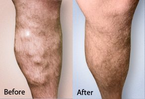 before and after photo of varicose vein treatment in the leg of a patient using VenaCure EVLT