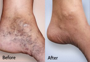 before and after photo of spider vein treatment on a patient's foot using Asclera