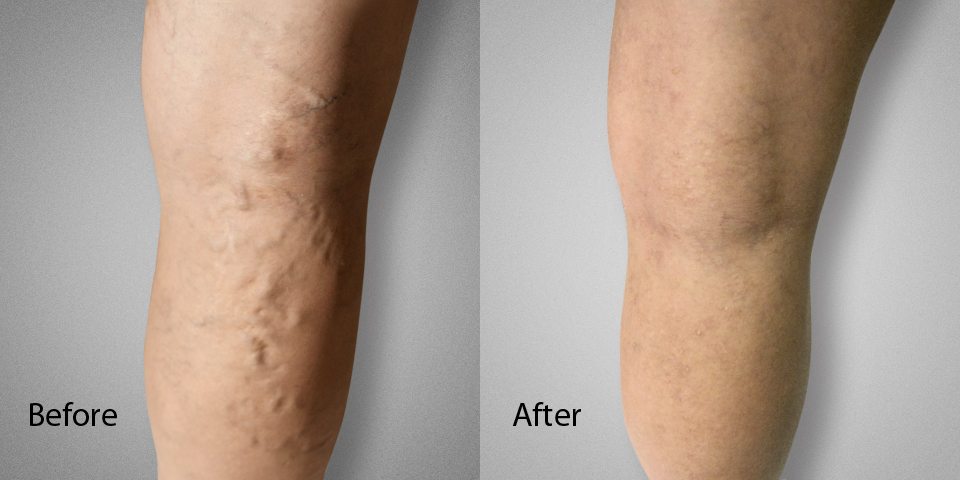 Best Treatments for Varicose Veins