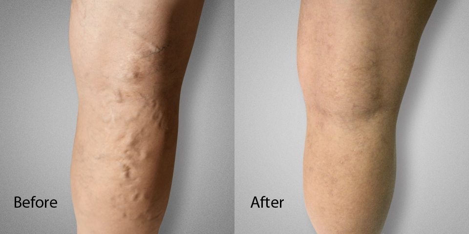 No Surgery; No Downtime: Sclerotherapy for Treating Varicose and