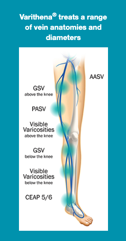 diagram illustrating the various vein anatomies and diameters that Varithea can treat in the leg